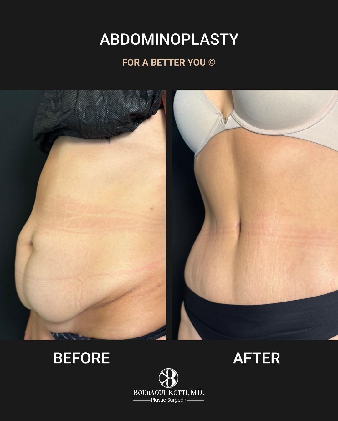 Abdominoplasty(tummy tuck)